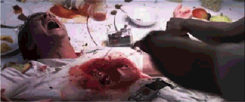 csection