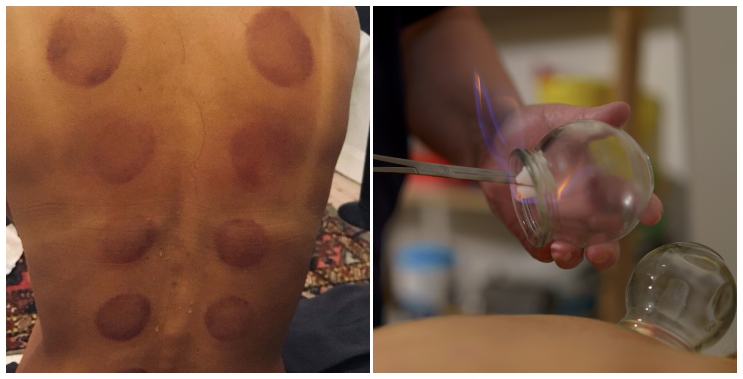 Cupping Individual I tried the cupping therapy popular with celebrities – and here is what ...